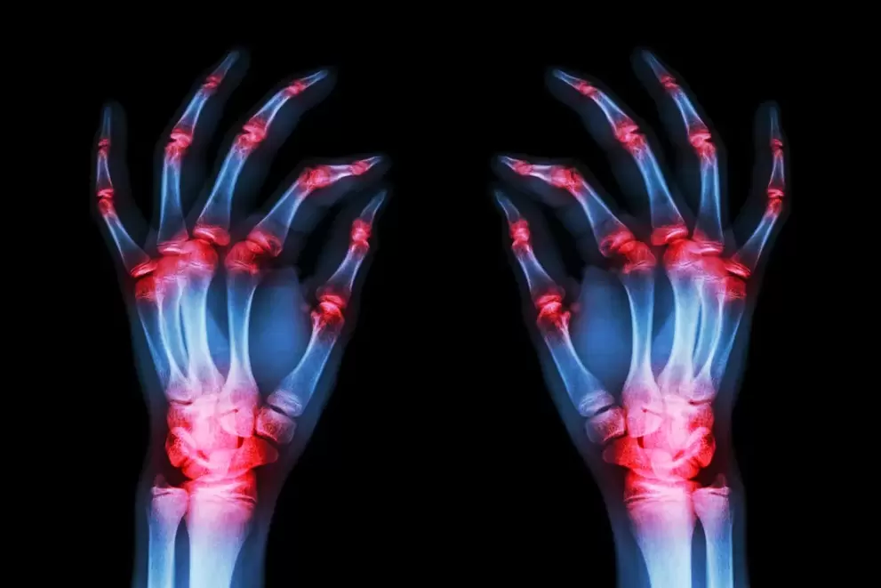 artróza kĺbov prstov