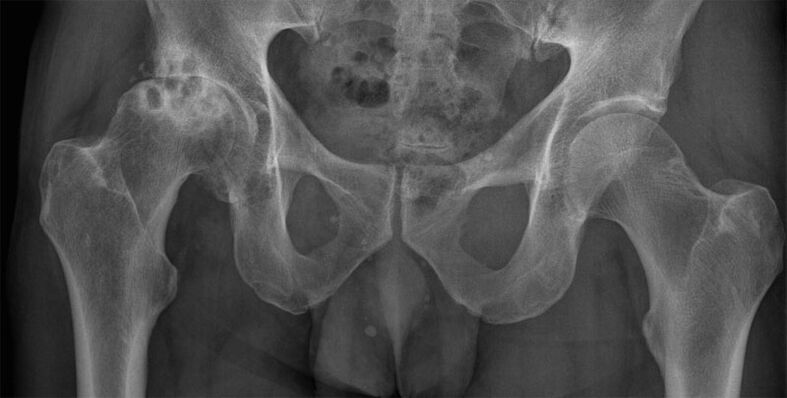 Artróza bedrového kĺbu v 3. štádiu na röntgene