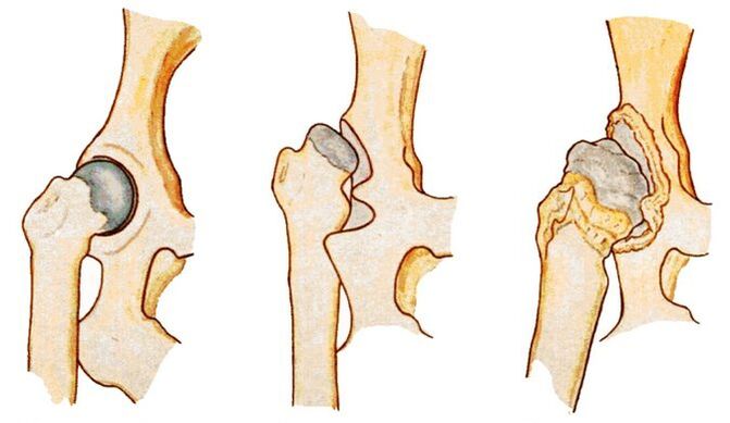 Dysplázia bedrového kĺbu je príčinou sekundárnej koxartrózy
