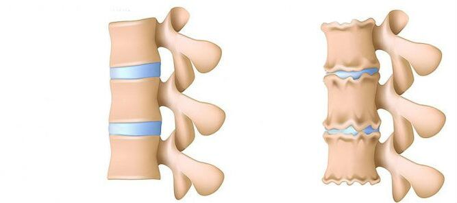 Osteochondróza zvnútra