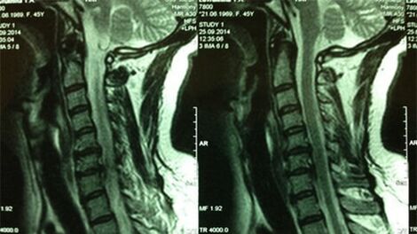 MRI krčka maternice