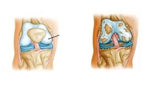 patologické zmeny v artróze kolena