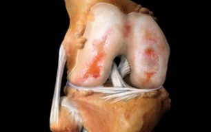 čo je artróza kolena