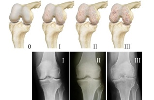 metódy diagnostiky artrózy kolena
