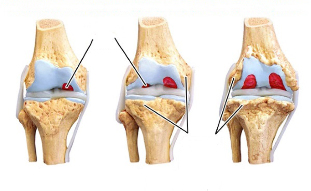 štádia artrózy kolena