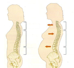 osteochondróza počas tehotenstva