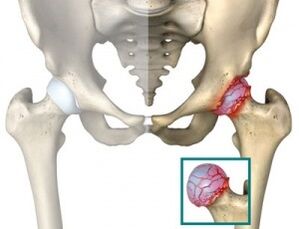 príčiny atrózy bedrového kĺbu