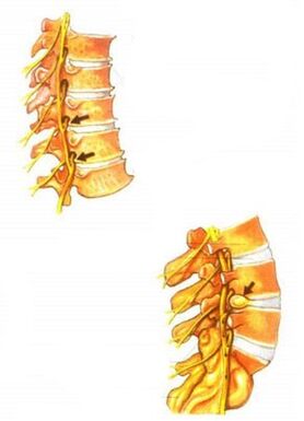 ilustrácia osteochondrózy chrbtice