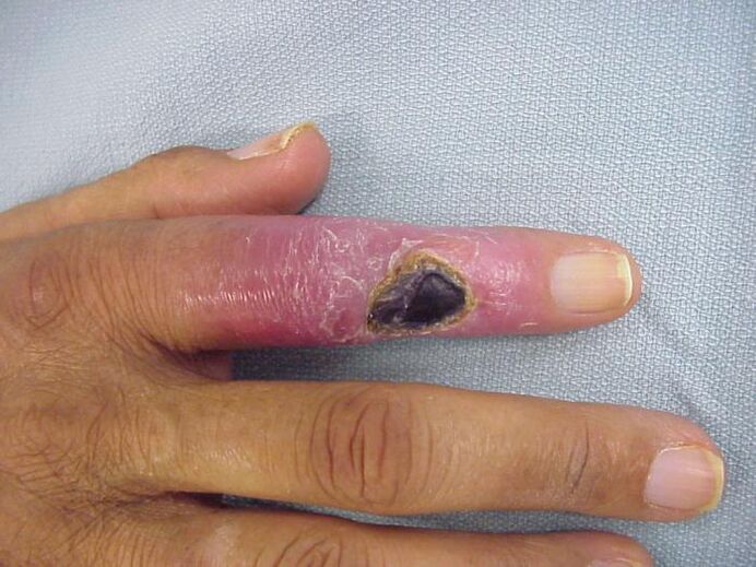 osteomyelitída ako príčina bolesti v kĺboch ​​prstov