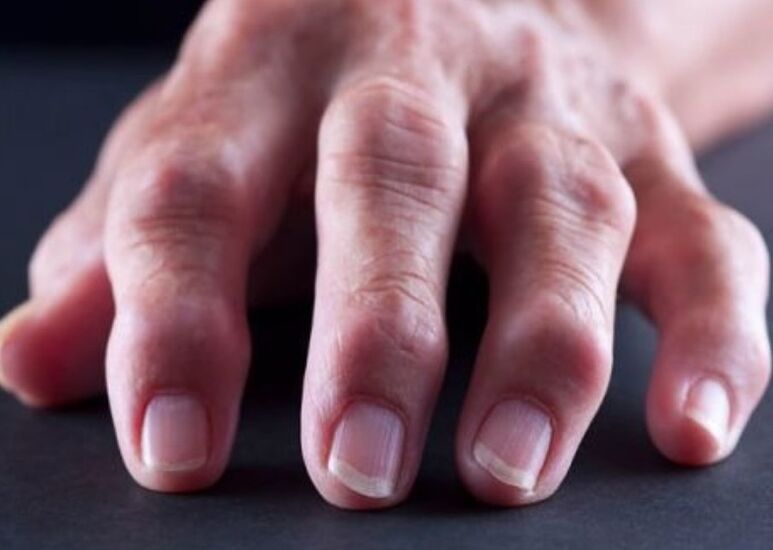 reumatoidná artritída ako príčina bolesti kĺbov prstov