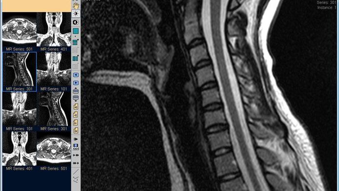 MRI krčnej chrbtice je najlepšou metódou na diagnostikovanie bolesti krku