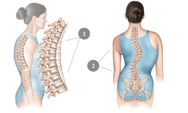 zakrivenie chrbtice ako príčina hrudnej osteochondrózy