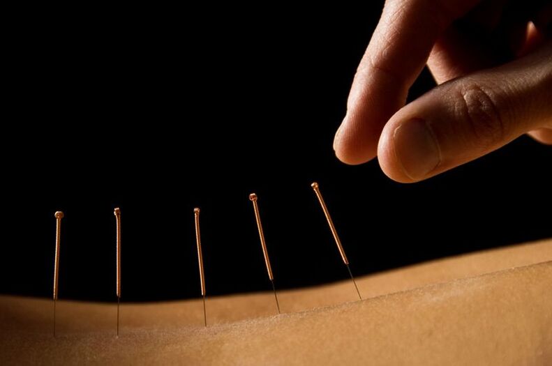 akupunktúra pri bolestiach chrbta