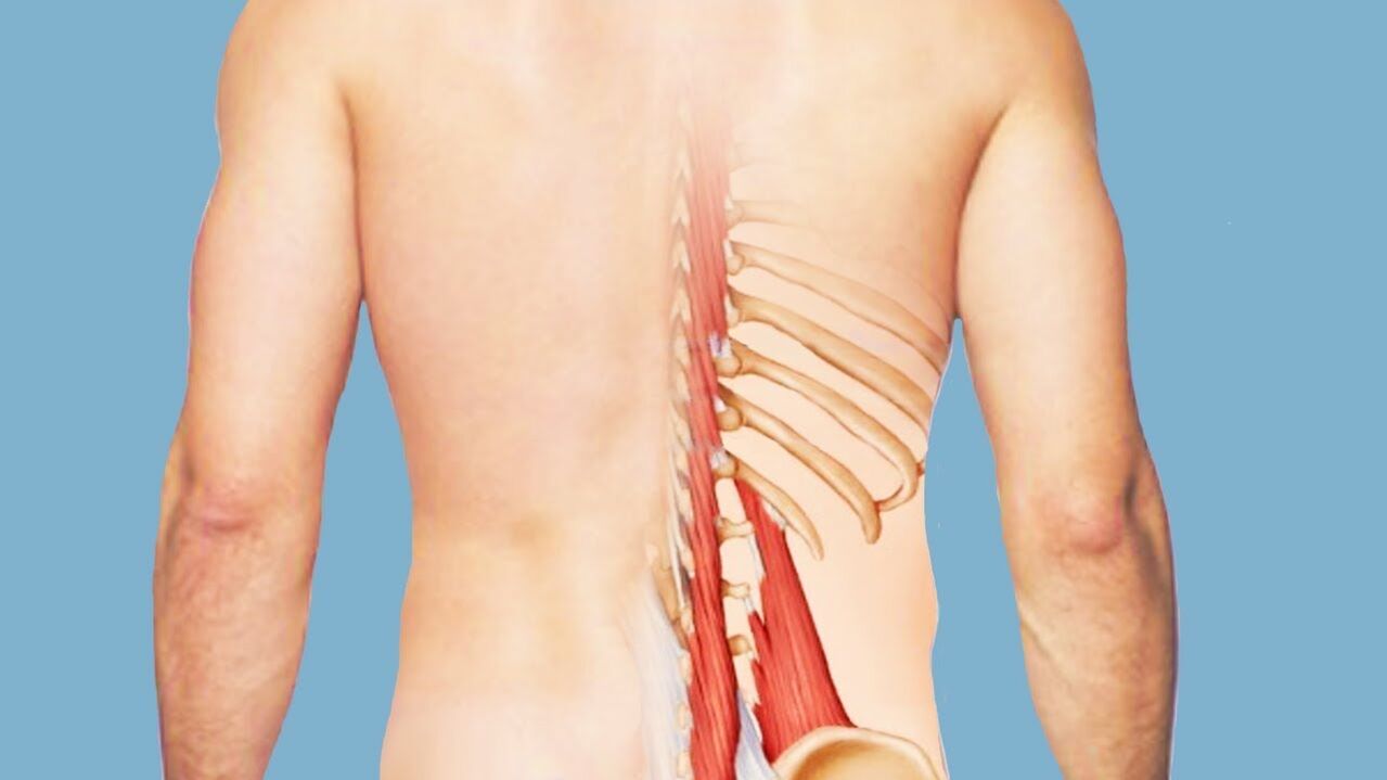 myozitída ako príčina bolesti chrbta