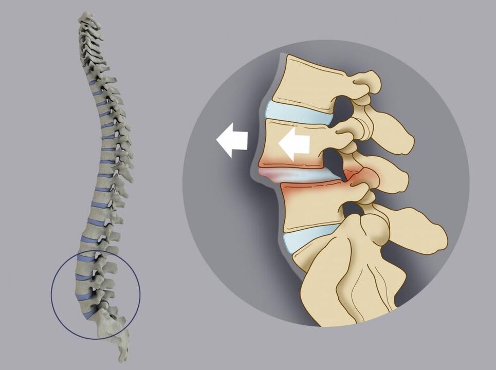 posunutie stavcov ako príčina bolesti chrbta