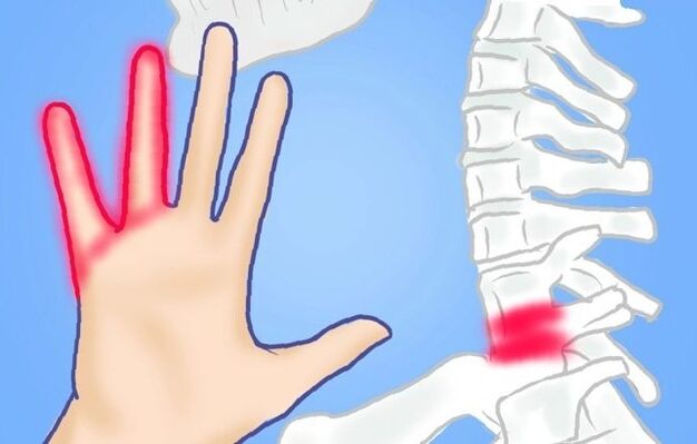 zovreté nervy ako príčina bolesti chrbta